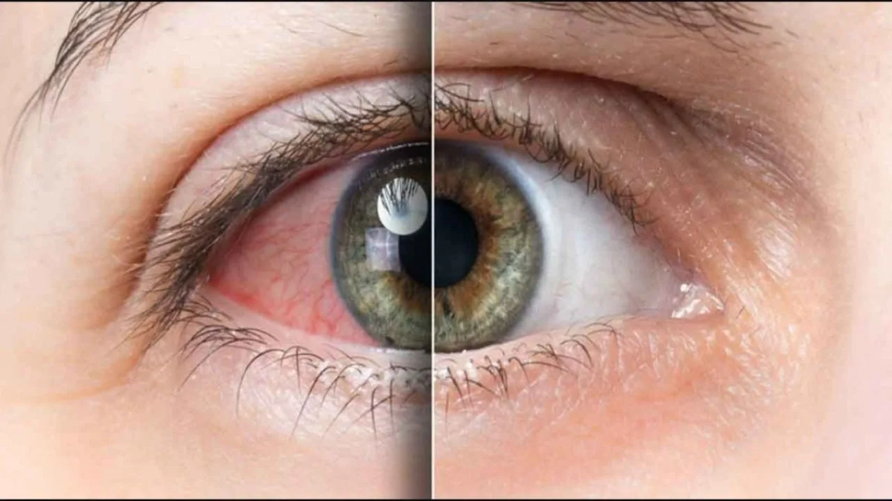 Changes in the vessels in retinal vein occlusion