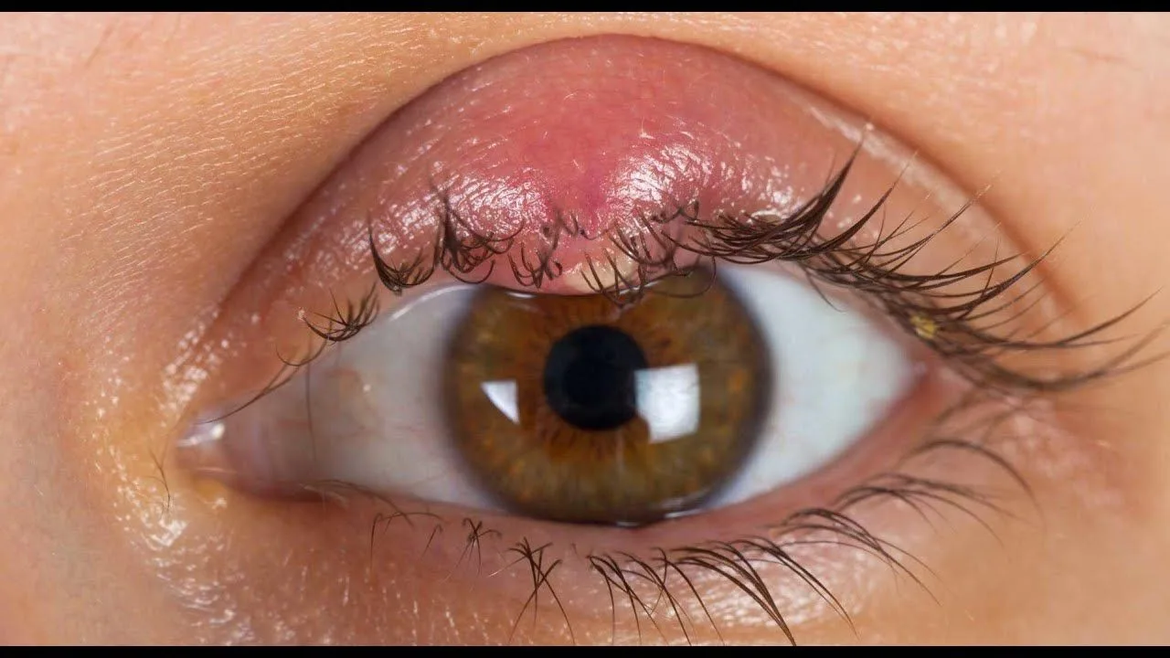 Stye on the eye