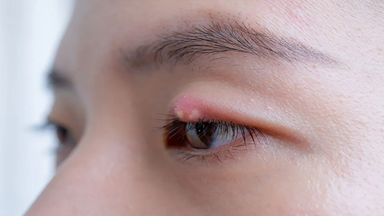 How to Get Rid of a Stye