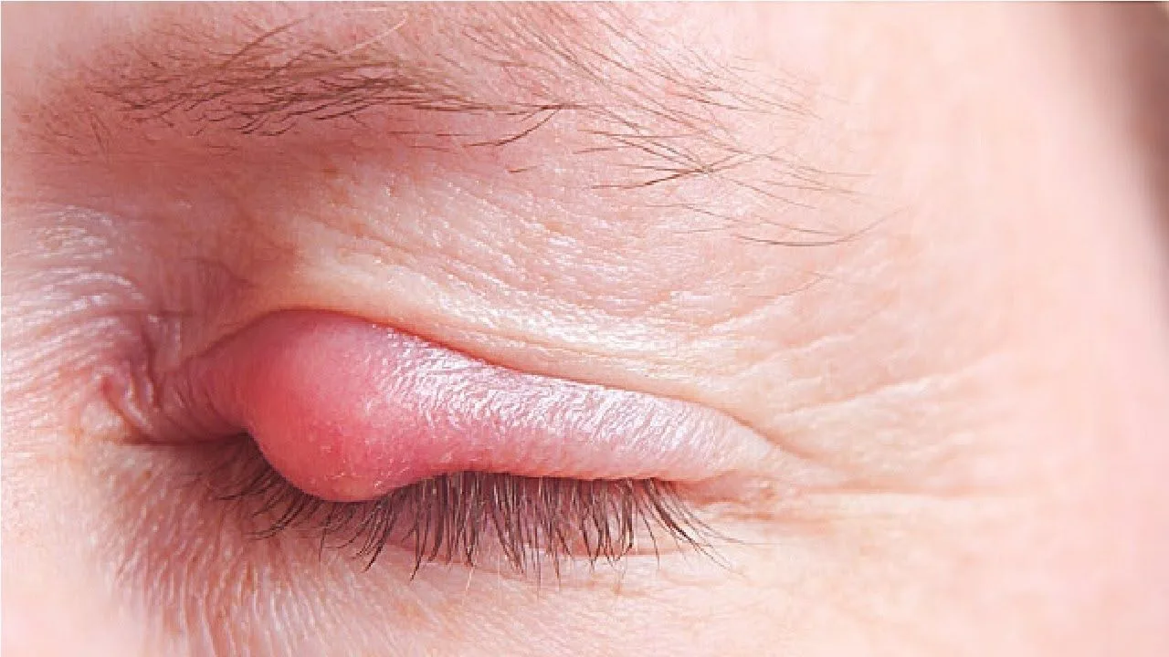 Symptoms of a stye