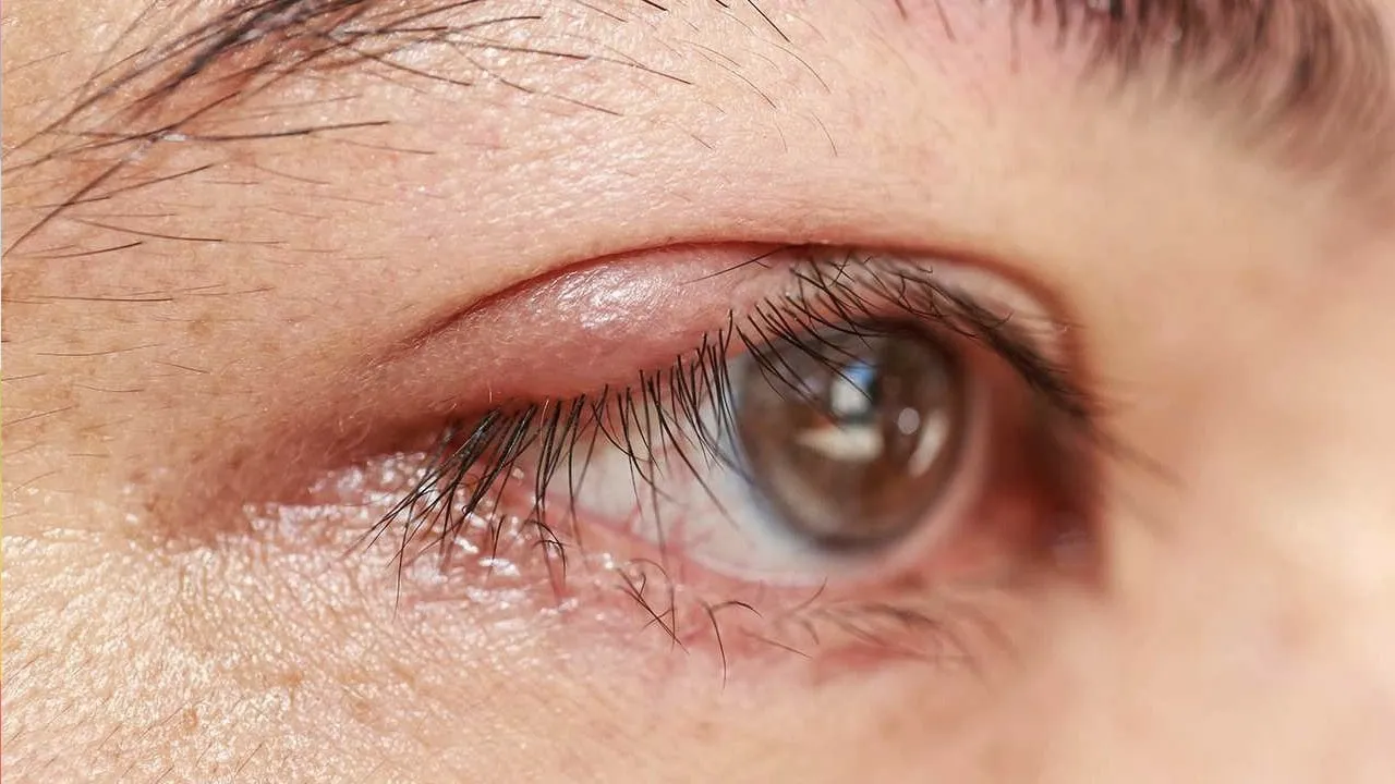 Stye on the eyelid