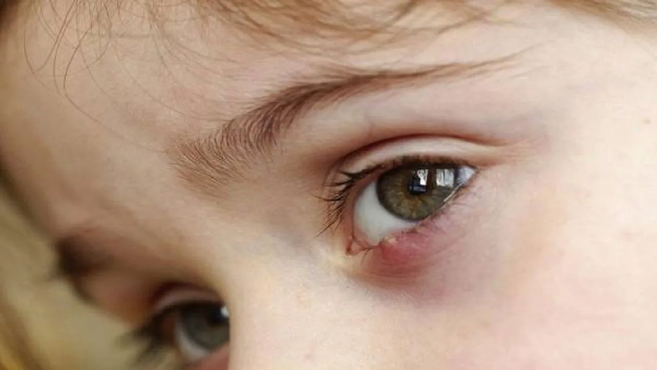 Stye treatment