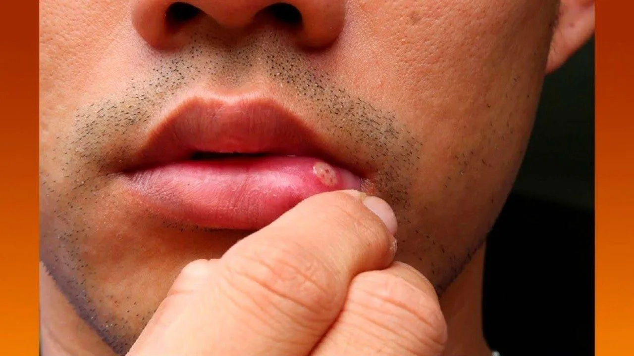 Behçet's disease