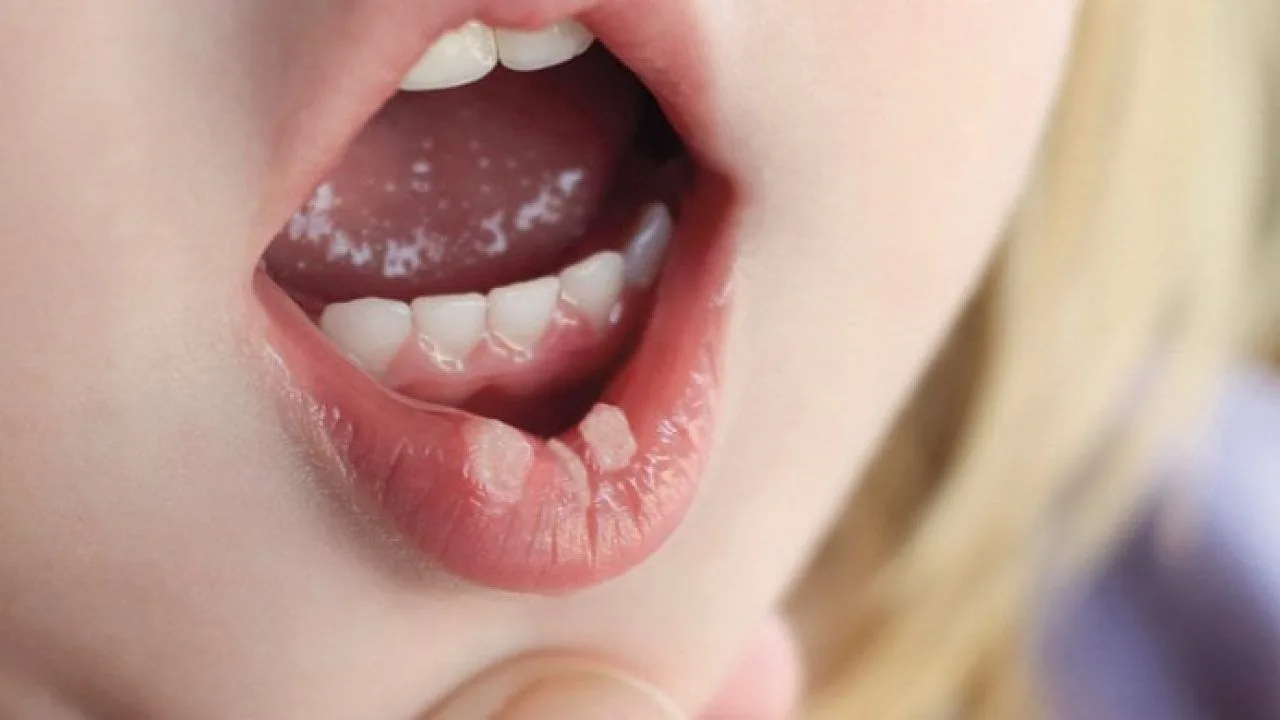 What is Behçet's Disease?
