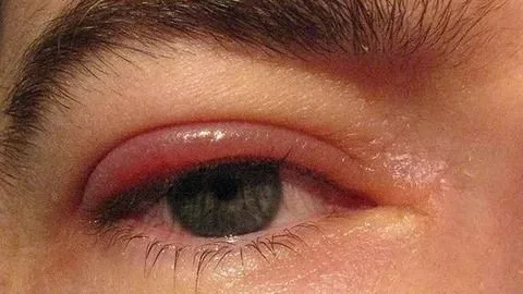 Blefaritis