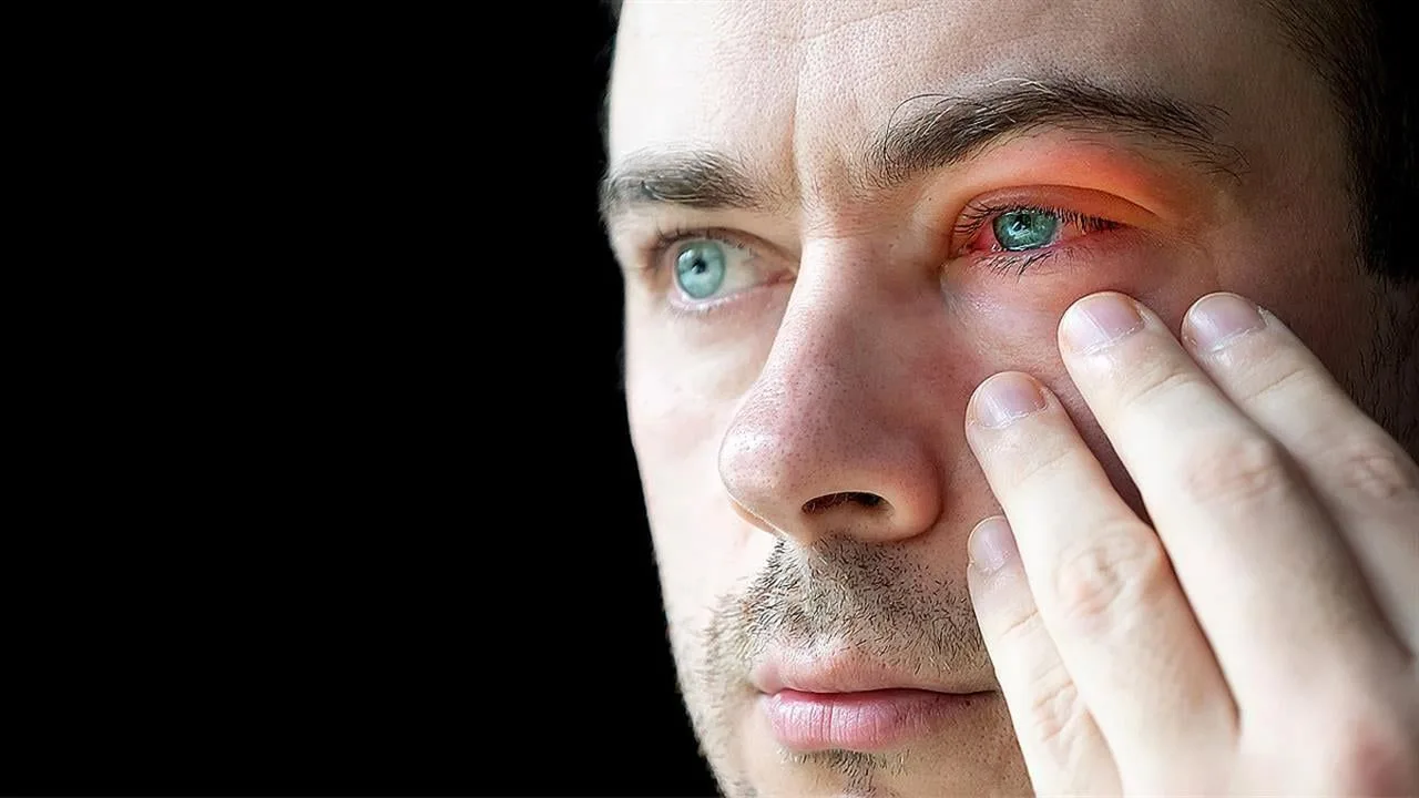 Blepharitis Treatment
