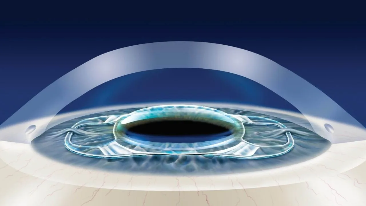 Intraocular lens implants Turkey