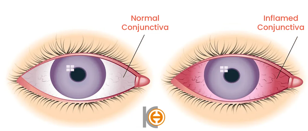 Bindvlies van het oog