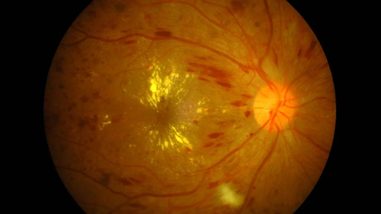 Diabetic retinopathy