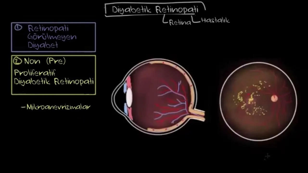 Stages of diabetic retinopathy