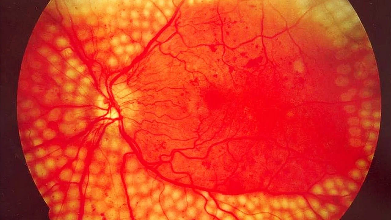 What is Diabetic Retinopathy?