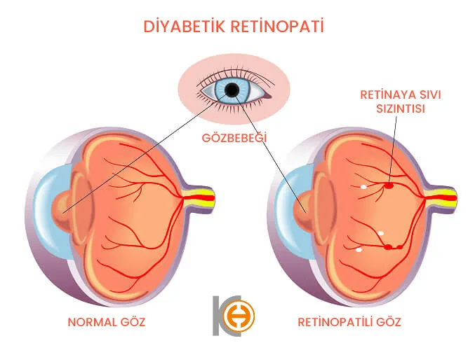 Diabetische Retinopathie
