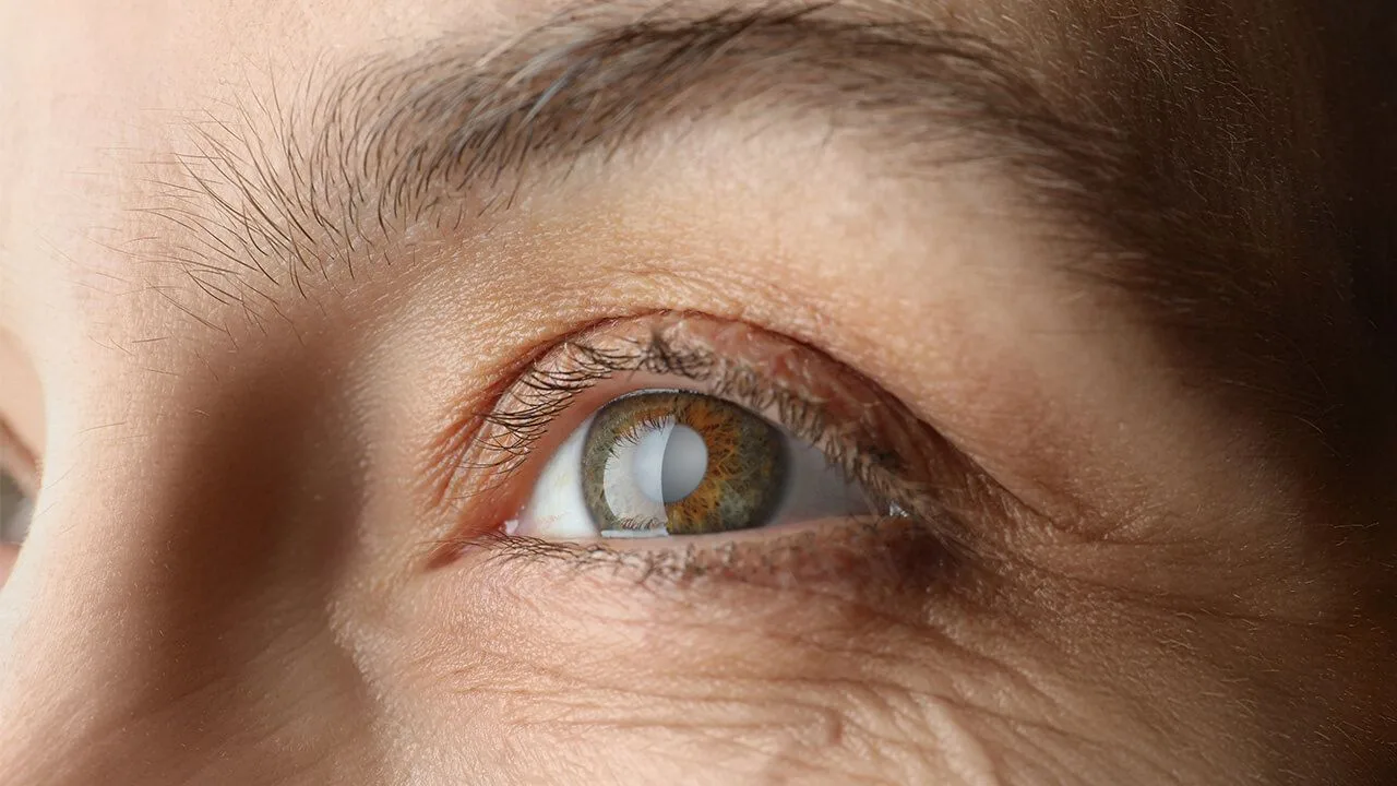 Waardoor ontstaat cataract op jonge leeftijd?