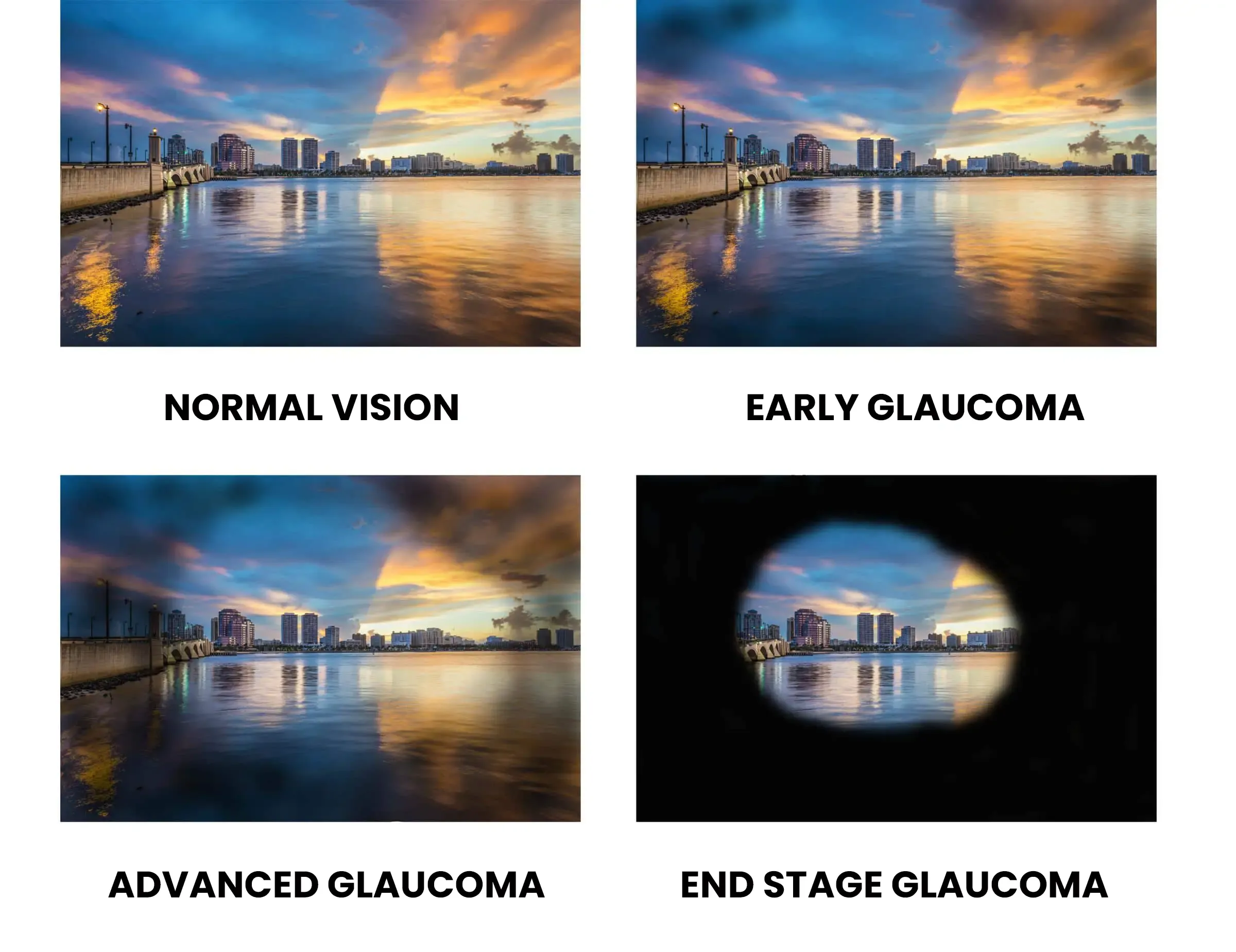 Glaucoom