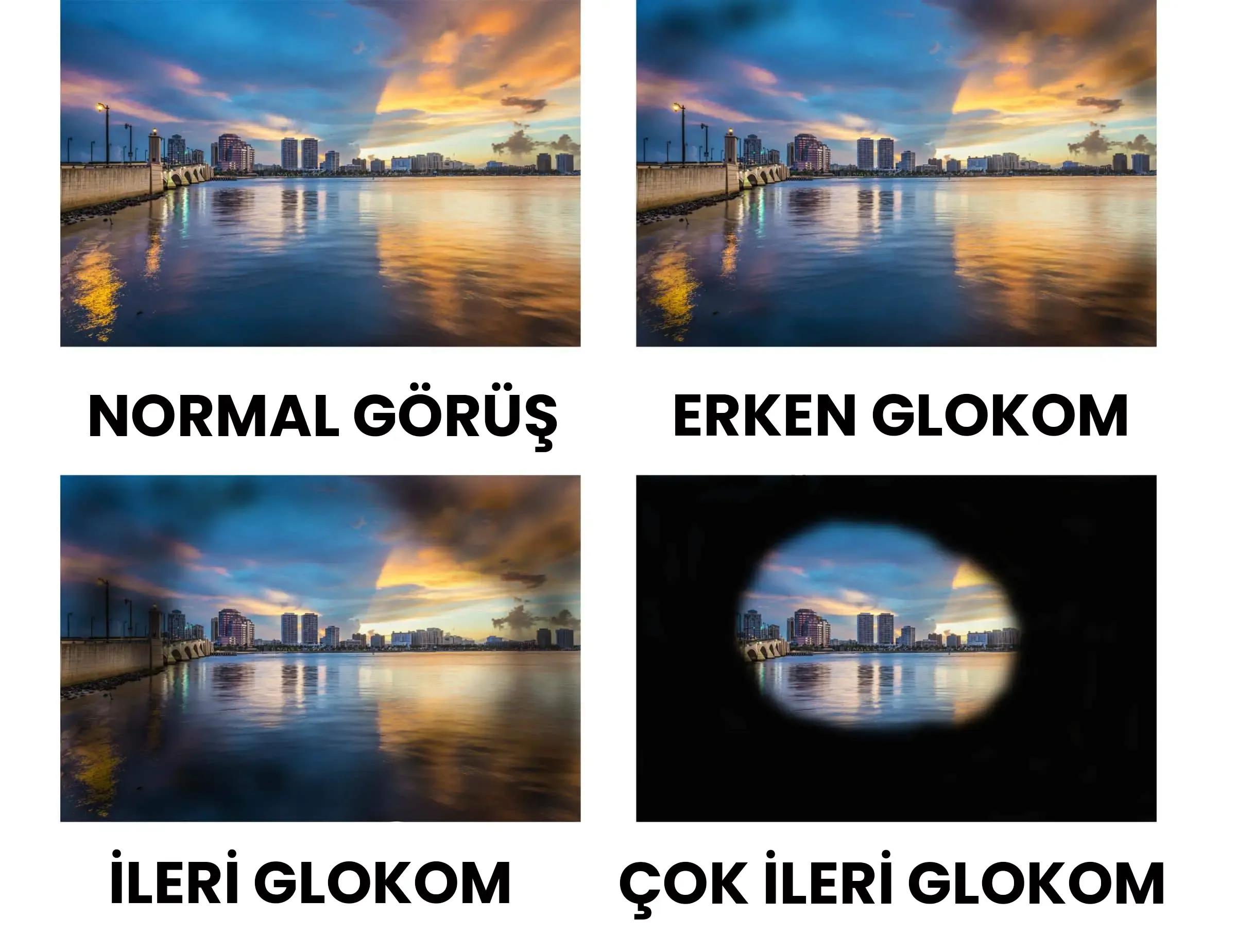 Glokom