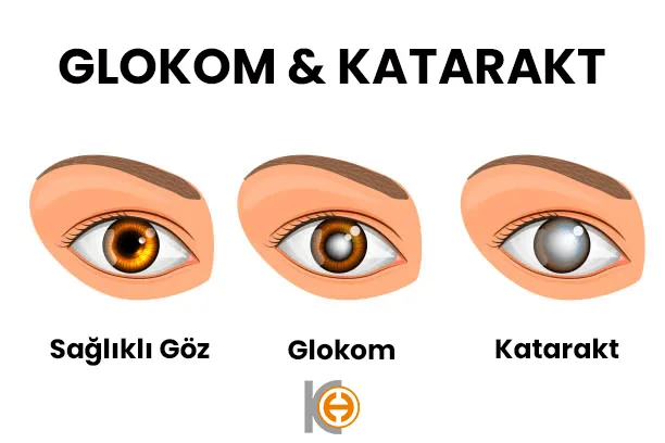 Glokom