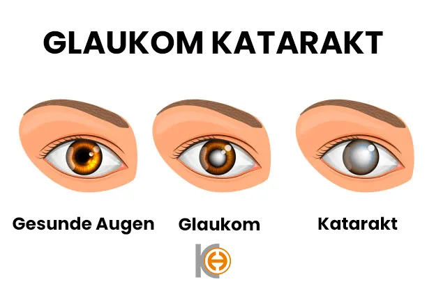Glokom
