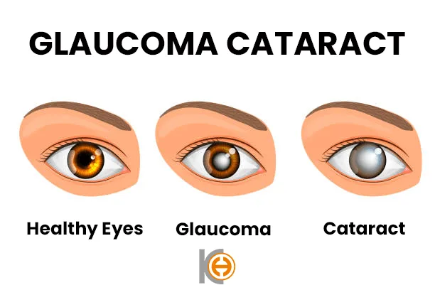 Glaucoom