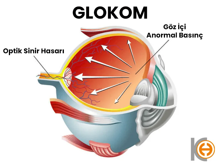 Glaucoom