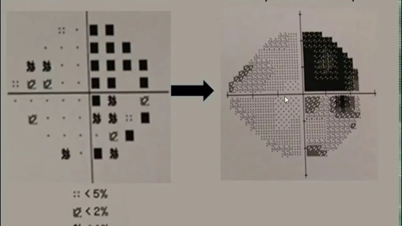 Wat is een gezichtsveldonderzoek?