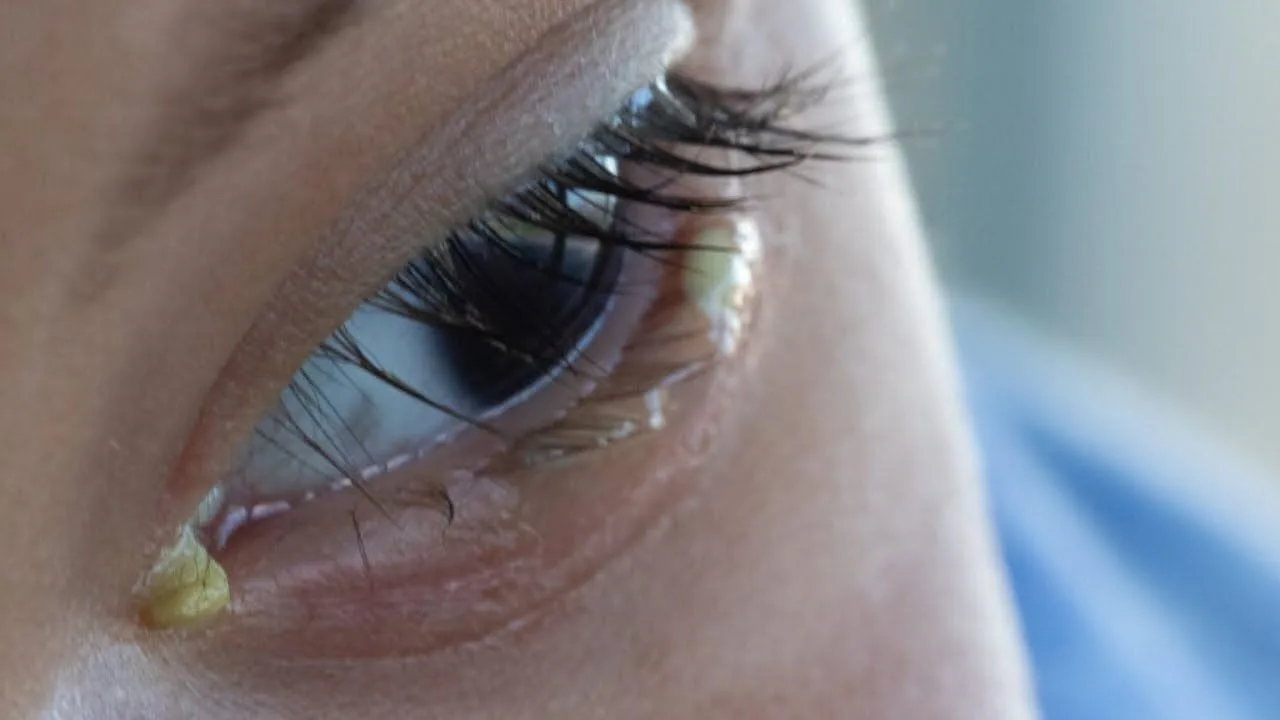 What Causes Eye Discharge?