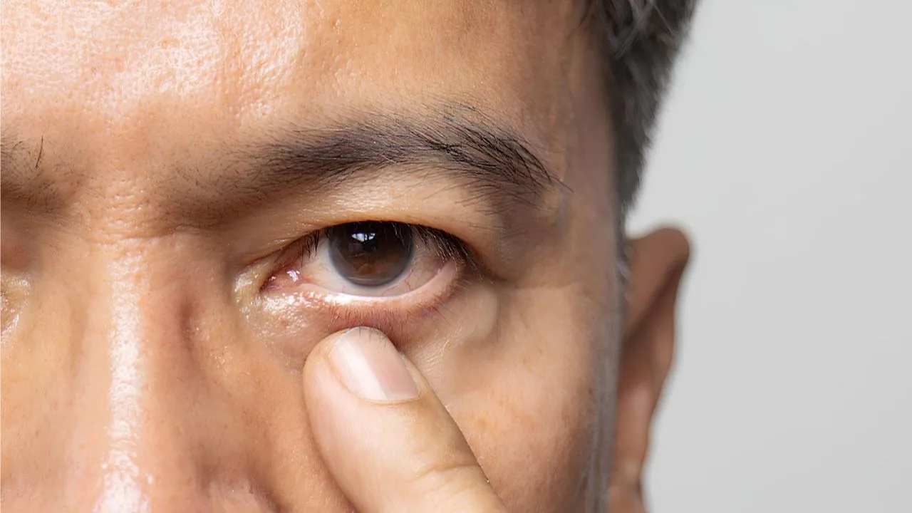 Vascular occlusion in the eye
