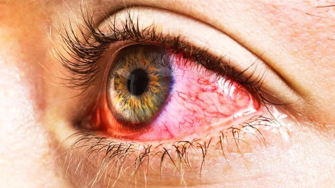 Are eye infections contagious