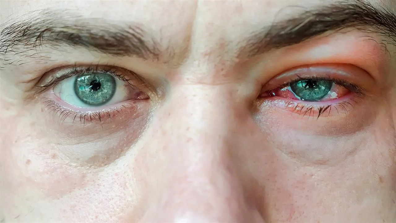 Eye infection