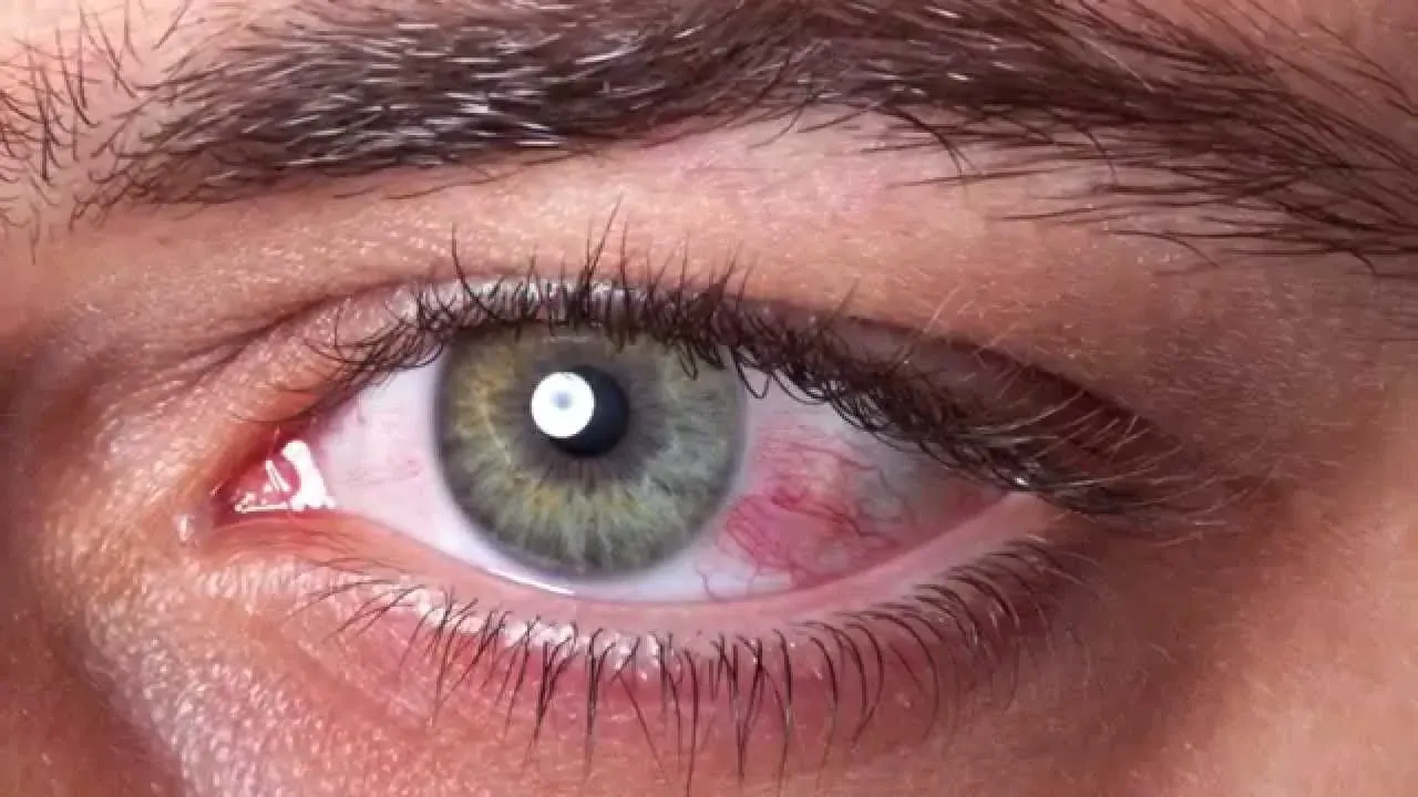 Was verursacht rote Augen?