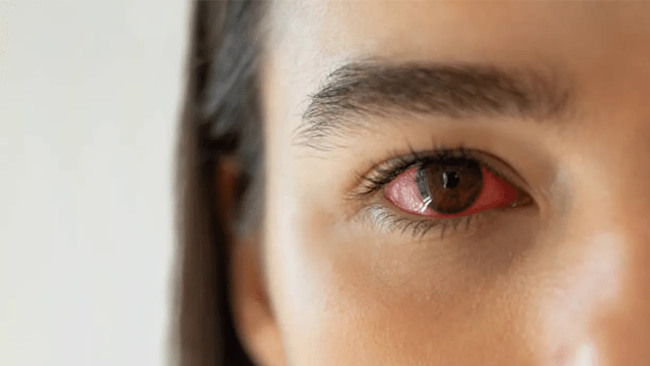 Bloodshot eyes
