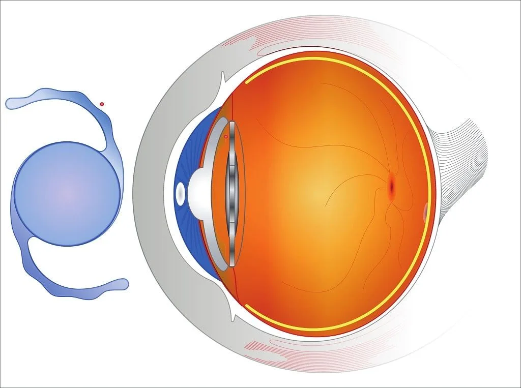 Prijzen van intraoculaire lenzen