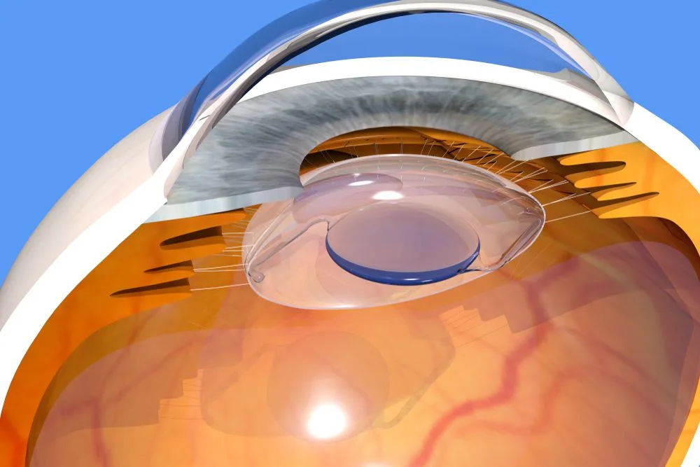 Lens in het oog