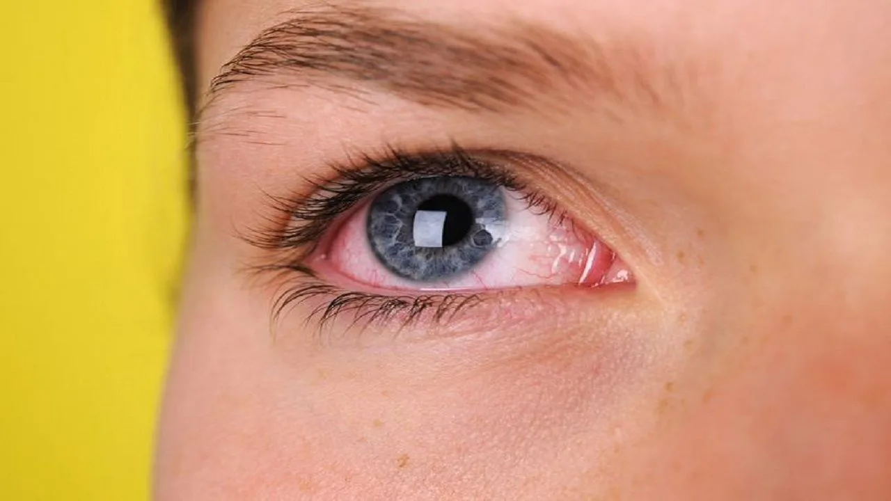 Causes of glaucoma