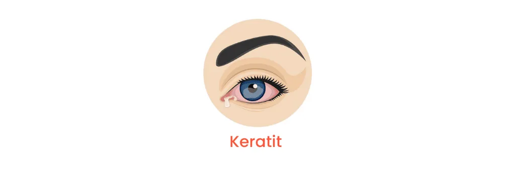 Keratitis