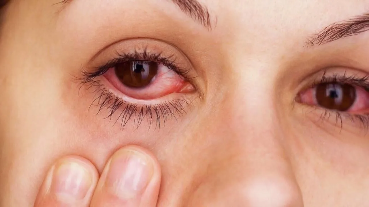 Ontsteking van het oog