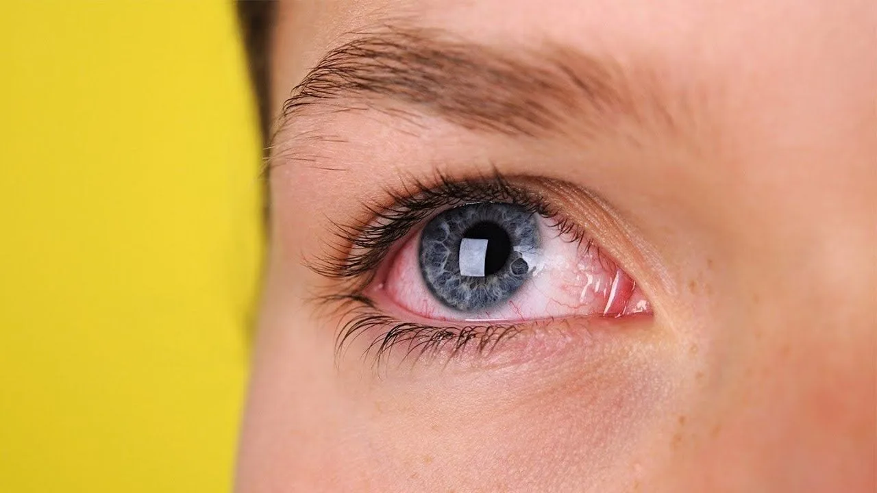 Ontsteking van het oog