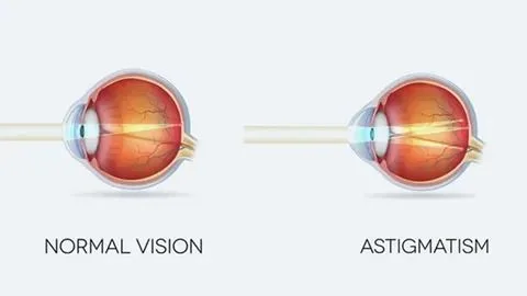 H52.2 astigmatism