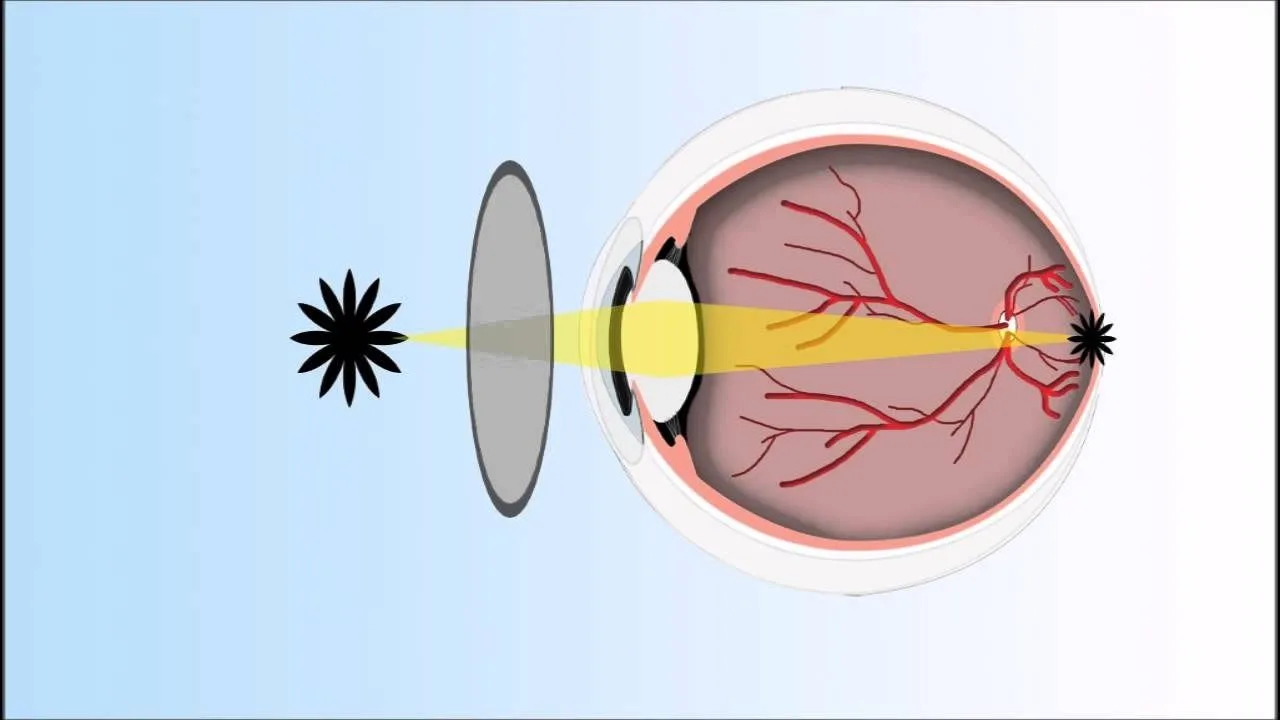 Degrees of astigmatism