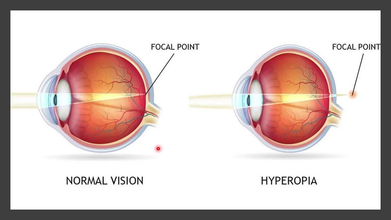 Causes of hyperopia