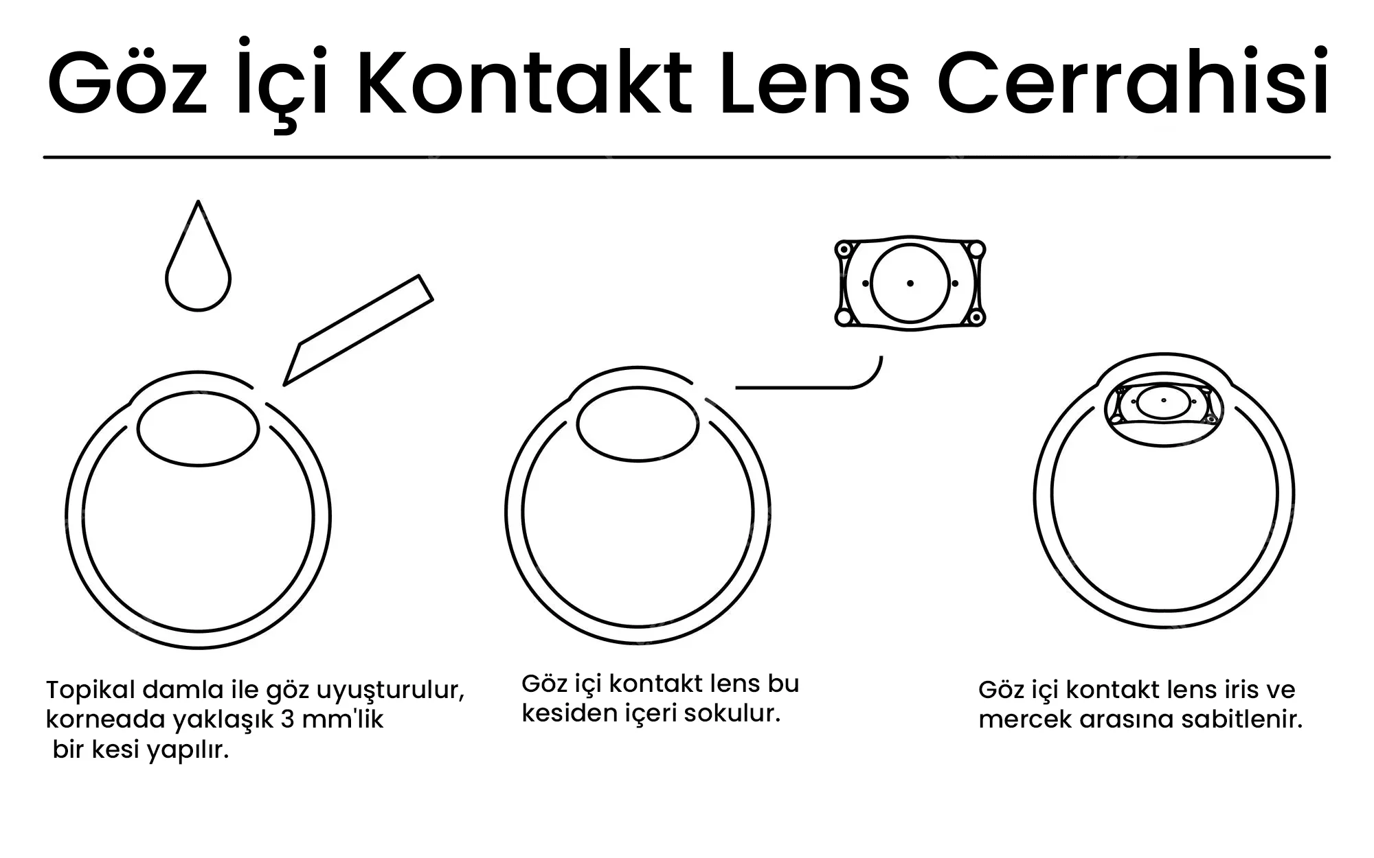 Schema van het plaatsen van een intraoculaire lens in het oog