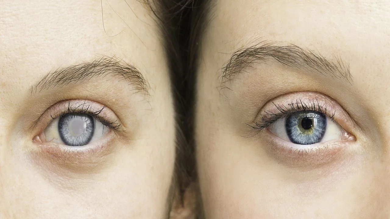 Op welke leeftijd ontstaat cataract?