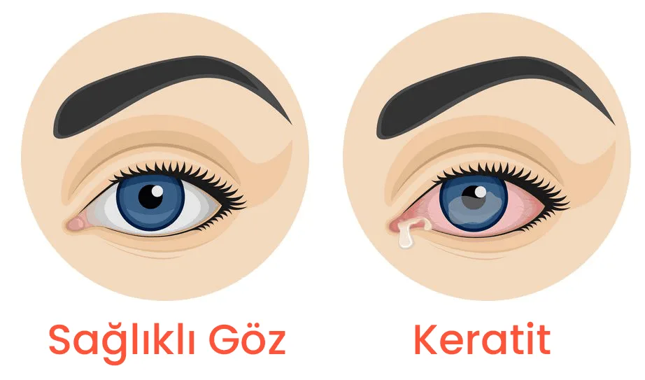 Keratit nedir?
