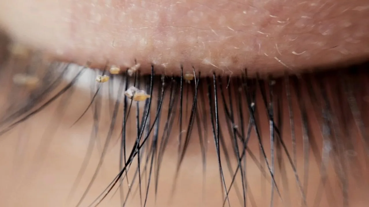 Inflammation at the lash line