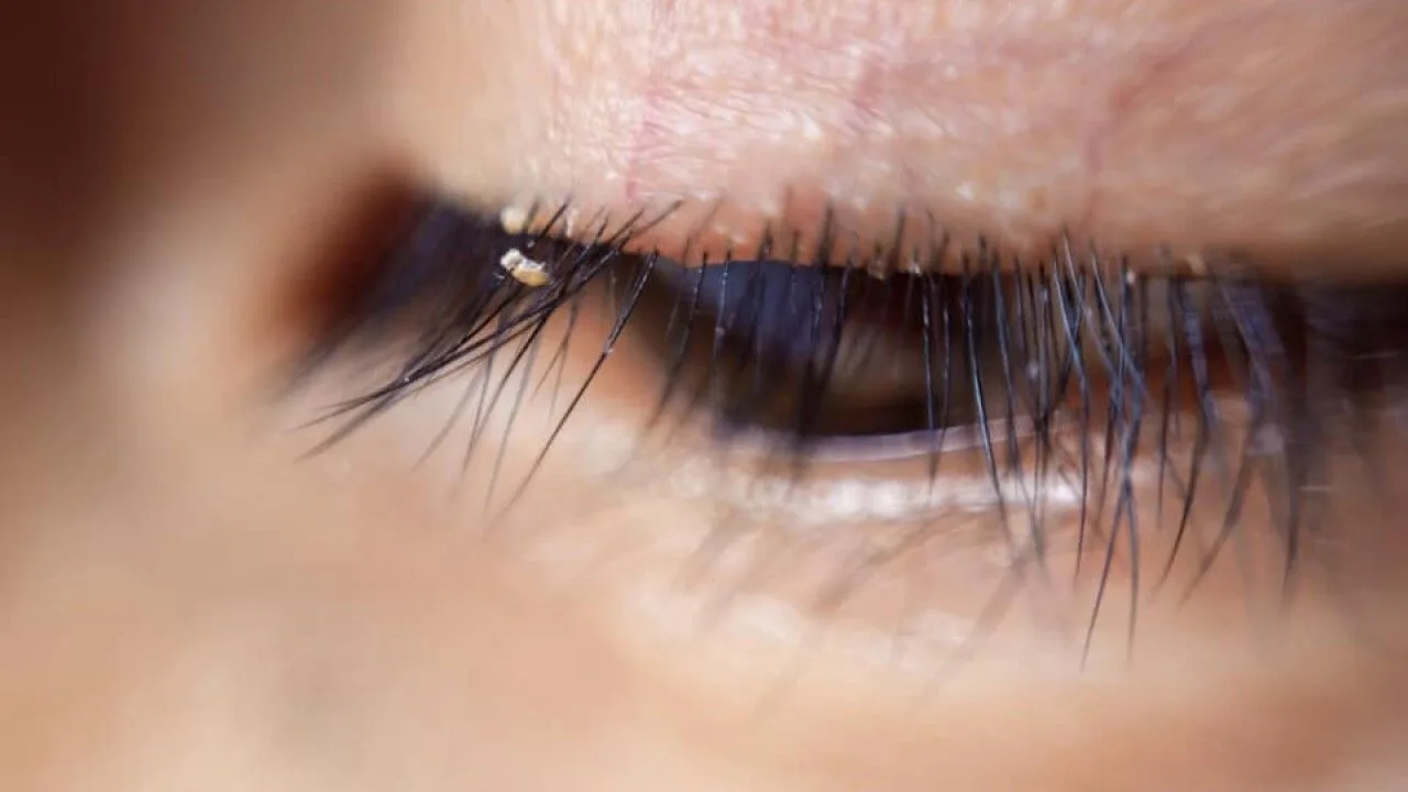 Causes of inflammation at the lash line