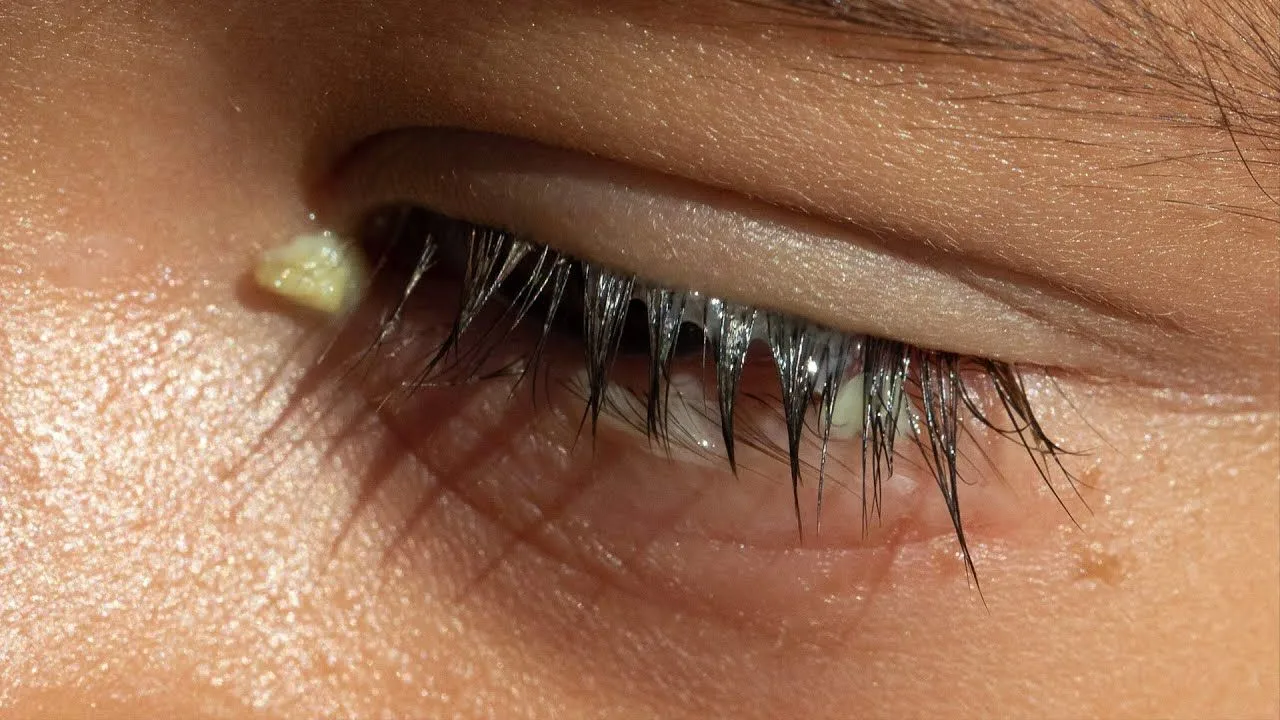 Hoe behandelt u een ontsteking aan de wimperrand?