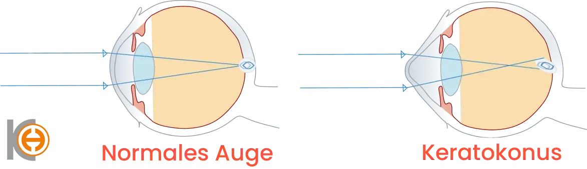 Kornea Keratoconus