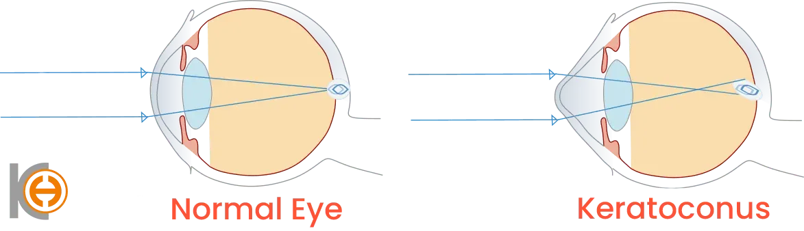 Hoornvlies bij keratoconus