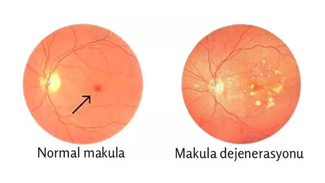 Maculadegeneratie