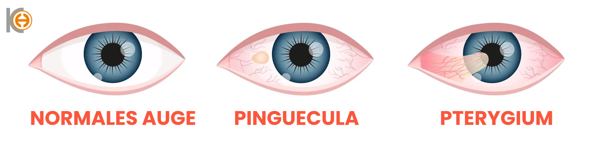 Pterjium