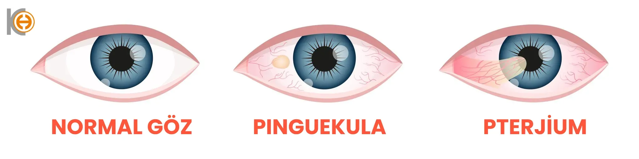 Pterygium